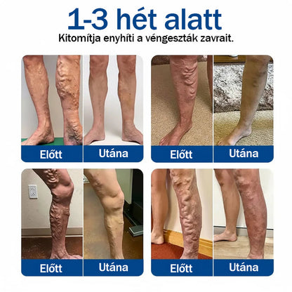 ✨🌿Medistart® Visszérápoló Mikrotűs Gondozó Tapasz ⚡ Azonnali Megkönnyebbülés, Hosszú Távú Eredmények