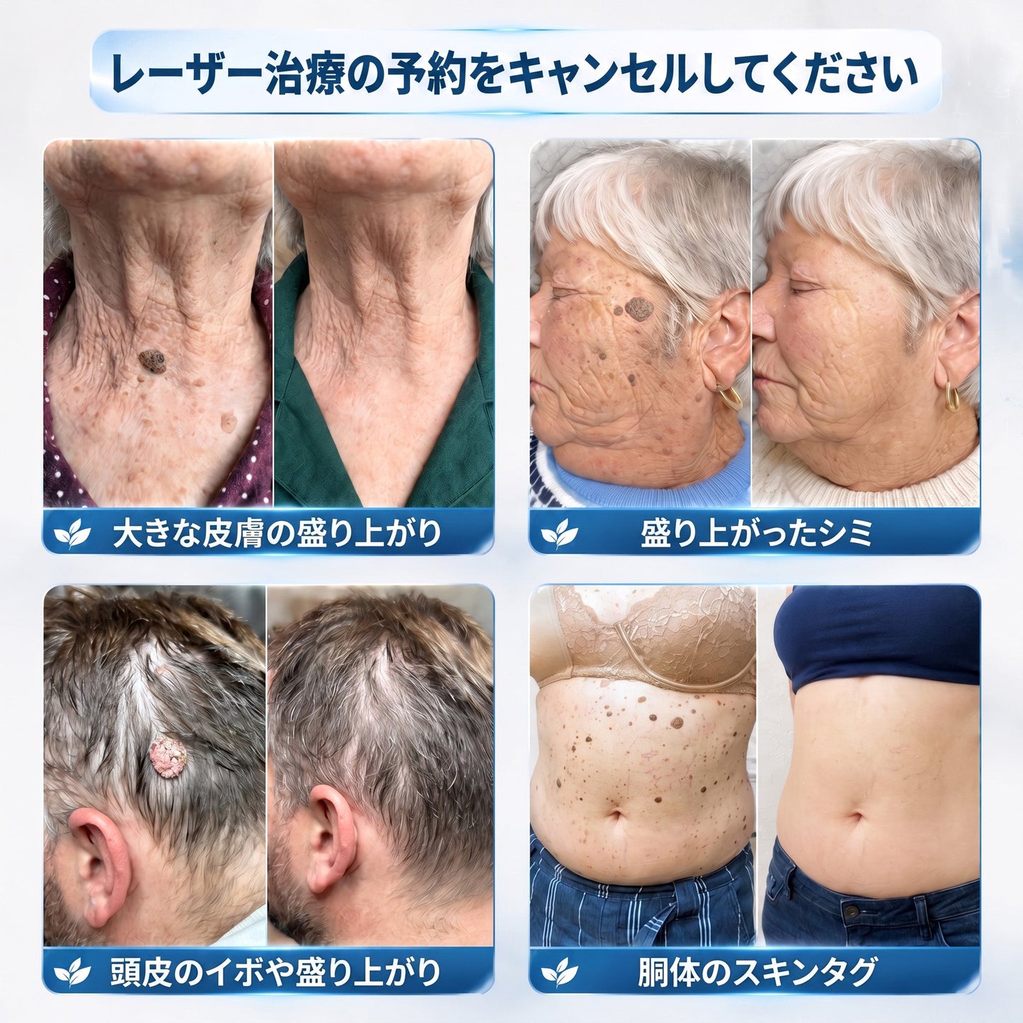 🎁🎁公式ストア𝐇𝐈𝐒𝐊𝐈𝐍®👩‍⚕️ 𝟕日間スキンタグ＆スポットイレーサー（ゼロ痛み・ゼロダメージ ローラーボール）