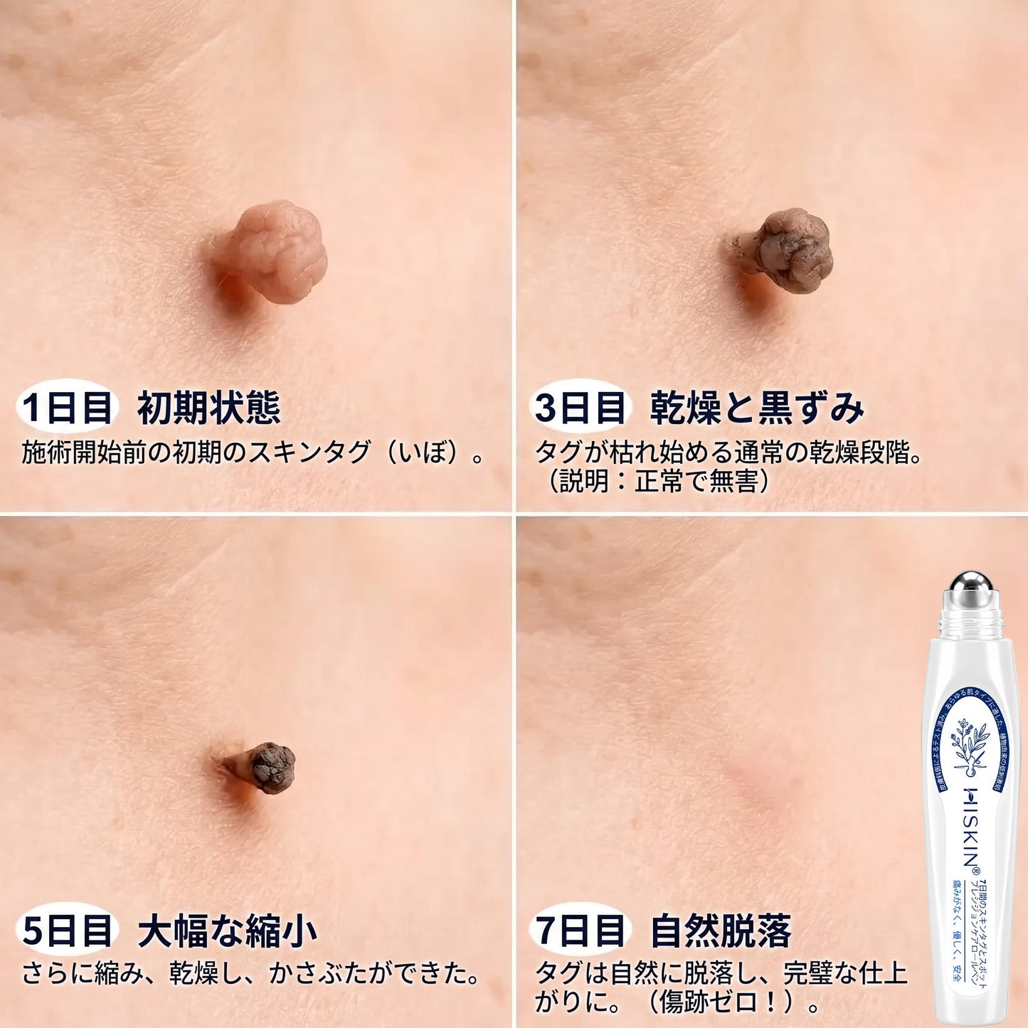 🎁🎁公式ストア𝐇𝐈𝐒𝐊𝐈𝐍®👩‍⚕️ 𝟕日間スキンタグ＆スポットイレーサー（ゼロ痛み・ゼロダメージ ローラーボール）